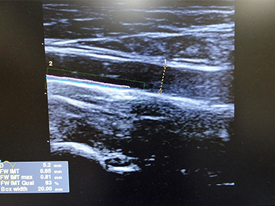 頸動脈超音波（頸動脈エコー）検査